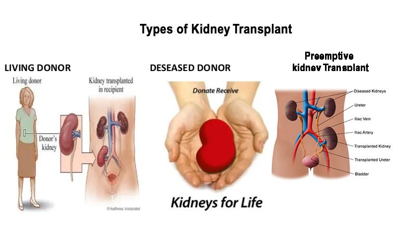 Types of Kidney transplant