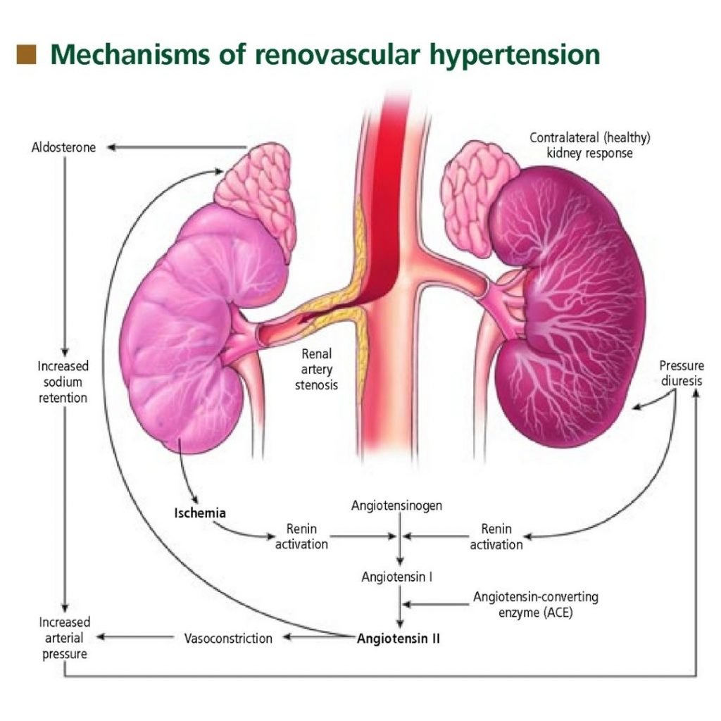 renal hypertension treatment