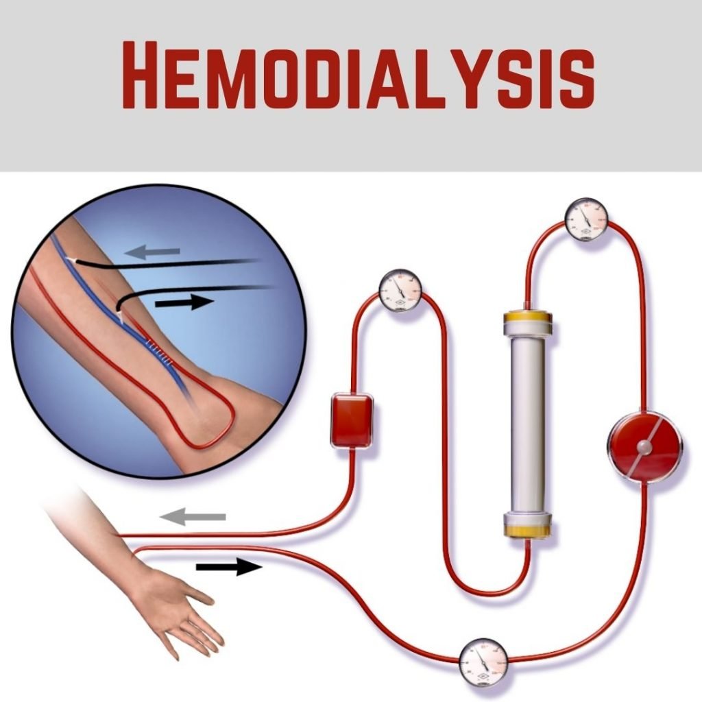 hemodialysis