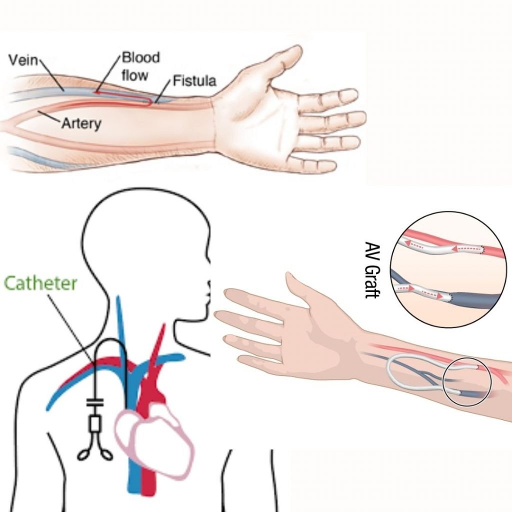 hemodialysis  causes